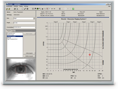OCULUS perimetry software: Glaucoma Staging System (GSS 2) per Brusini