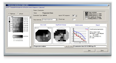 OCULUS perimetry software: Threshold Noiseless Trend (TNT) Progression Analysis